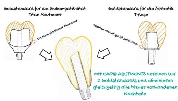 Goldstandards mit Nachteilen Lösung EAP Abutments